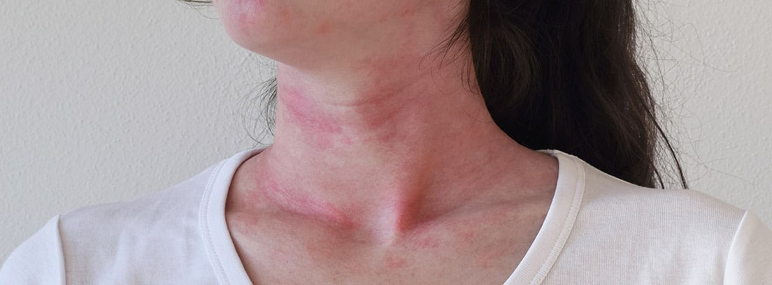 Toxicodermias: erupción en el piel del cuello y cara de una mujer