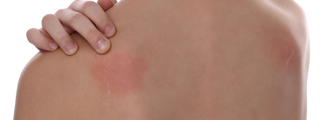 Espalda de un niño con una reacción en la piel por una alergia