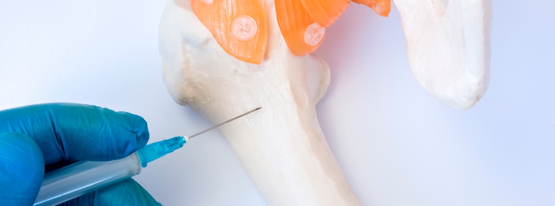 ¿Cómo se realiza una biopsia de médula ósea?-canalSALUD