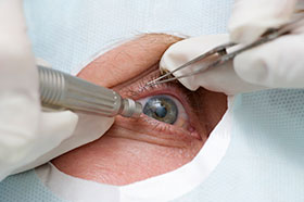 cirugía del ojo