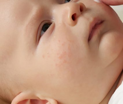 Virus Herpes Simple Durante El Embarazo Canalsalud Virus Herpes Simple Durante El Embarazo Canalsalud