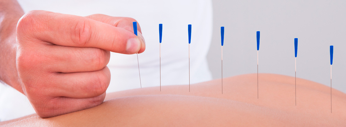 Tipos de agujas de acupuntura y su funcionalidad