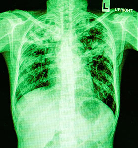 radiografía de toráx, neumonía