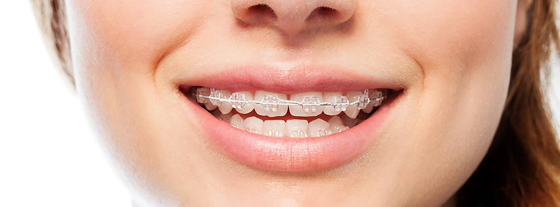 Mujer con una sonrisa con bracketts