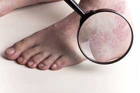 Psoriasis