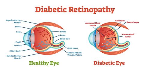 esquema sobre la retinopatia