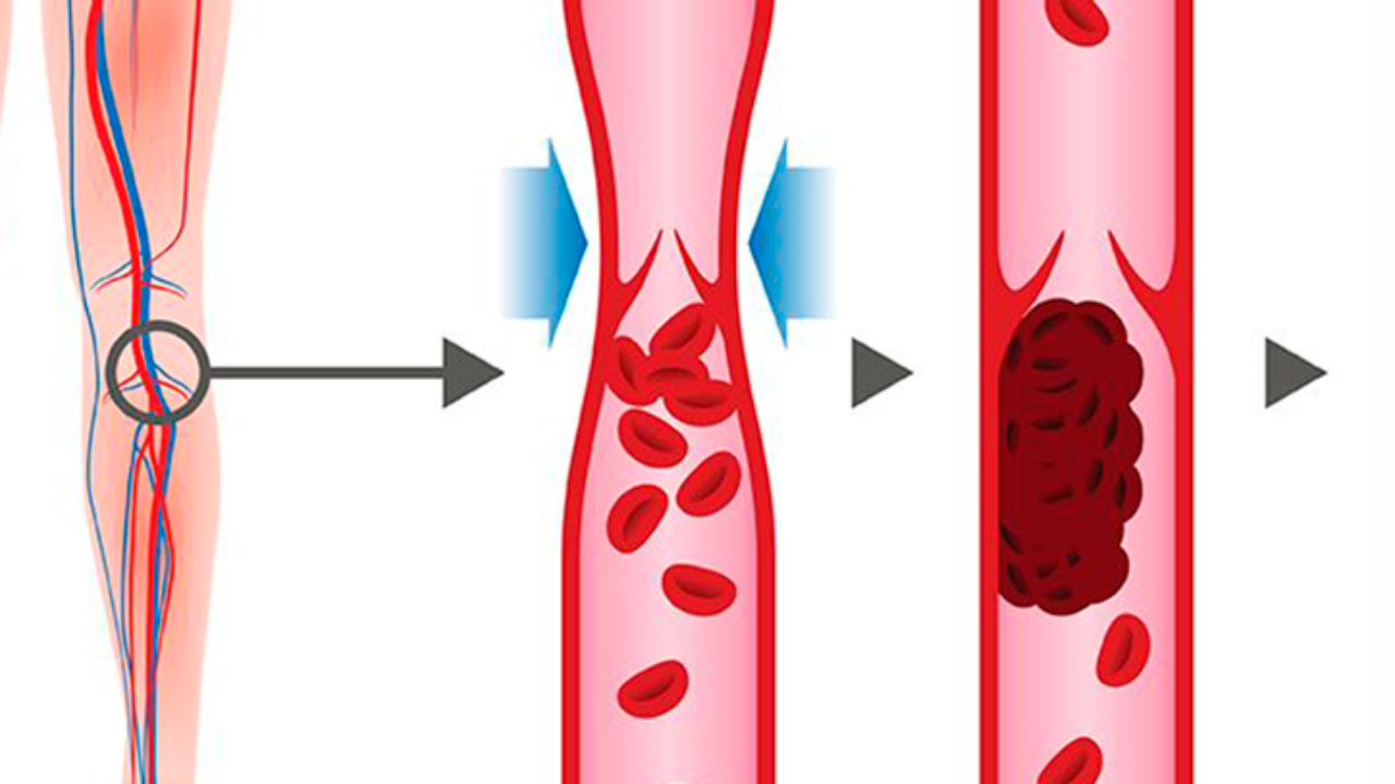Застой крови у мужчин. Как диагностировать тромбы. Диагностика тромбозов показатели.