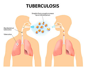 tuberculosis pulmonar