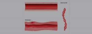 Vasculitis y tipos: dibujo de vasculitis