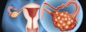 Cáncer de ovario: imagen representando el cáncer de ovario