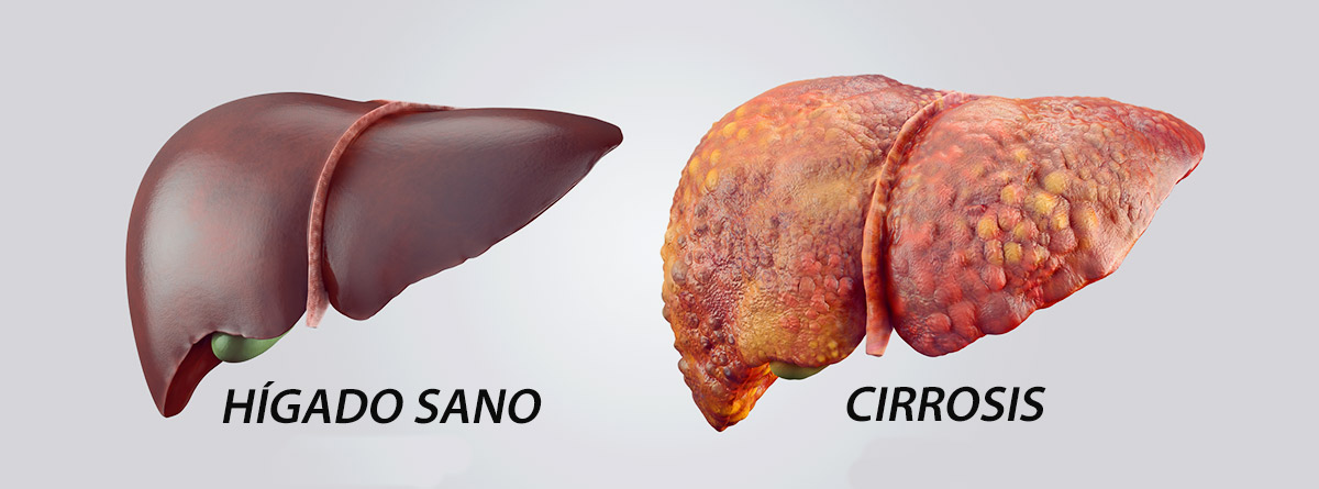 Cirrosis: imágen de higado sano e hígado con cirrosis