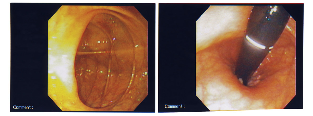 Colonoscopia y rectoscopia: imágenes de colonoscopia