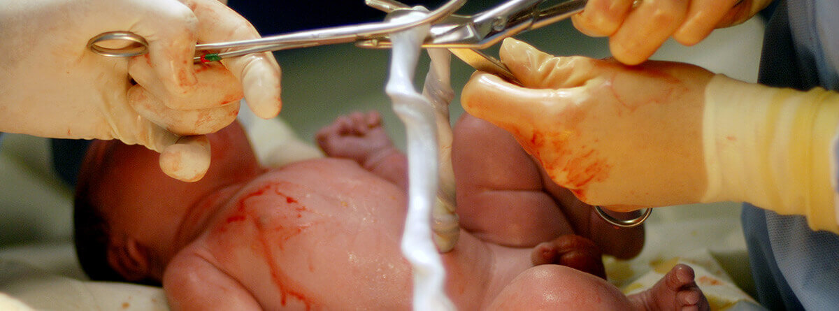 El cordón umbilical: recien nacido y doctores cortando el cordón umbilical