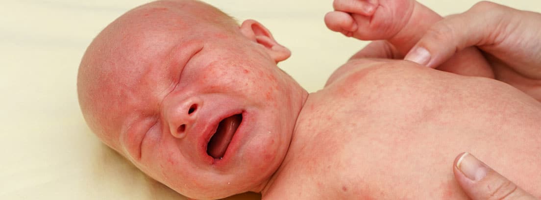Cutis marmorata: bebé con problemas en la piel