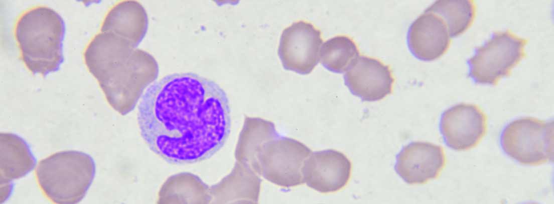 células leucémicas