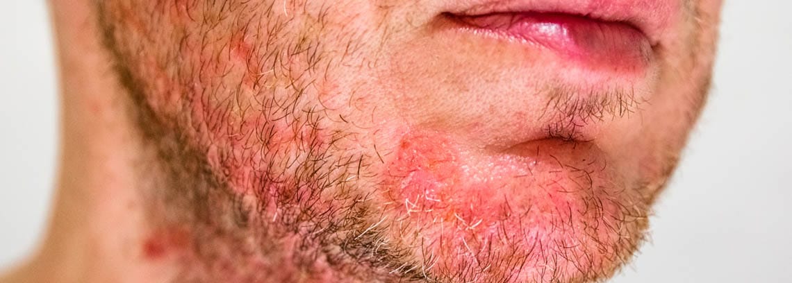 hombre con dermatitis seborreica en la barba