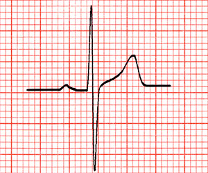 electrocardiograma