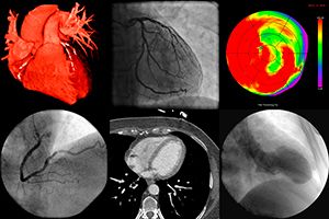 spect-cardiaco3