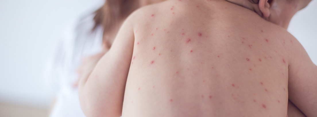 espalda de un niño pequeño con varicela