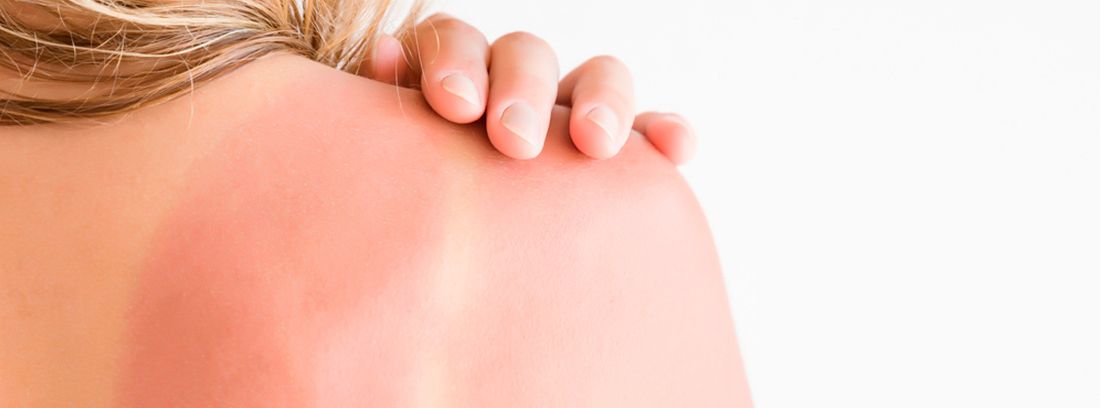 detalle de la espalda quemada por el sol de una mujer