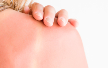 detalle de la espalda quemada por el sol de una mujer