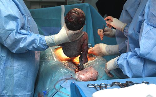 nacimiento de un bebé en quirófano