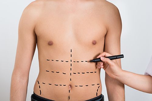 señalización en abdomen de hombre para una cirugia