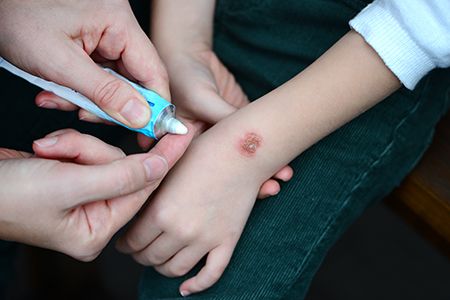 quemadura en brazo de niño y manos aplicando una pomada