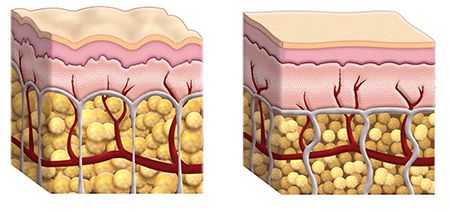 celulitis