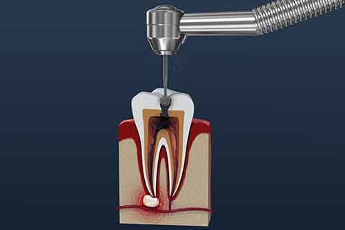 endodoncia