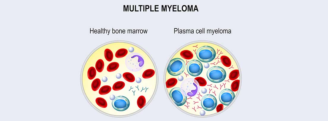 Células de Mieloma Múltiple