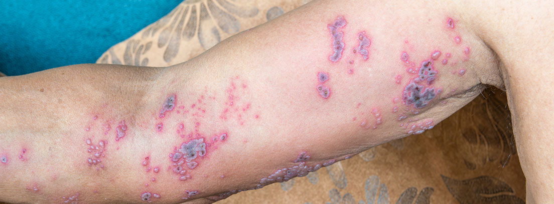 brazo infectado por el virus del herpes zoster