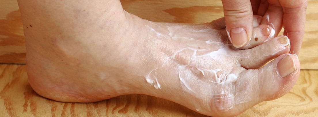 Infecciones micóticas de la piel: mujer echandose crema en los pies