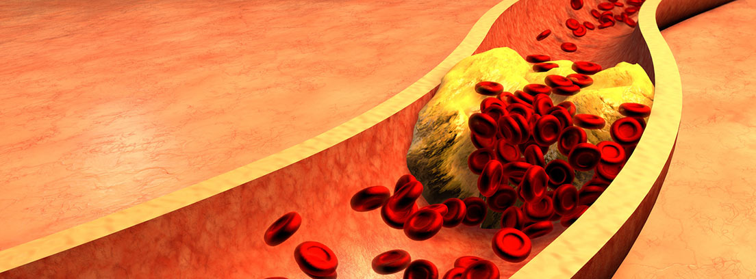 Arteria atascado con las plaquetas y el colesterol