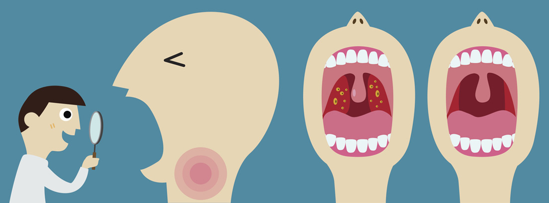 Patológico Herencia código postal Placas en la garganta y otros síntomas de anginas-canalSALUD