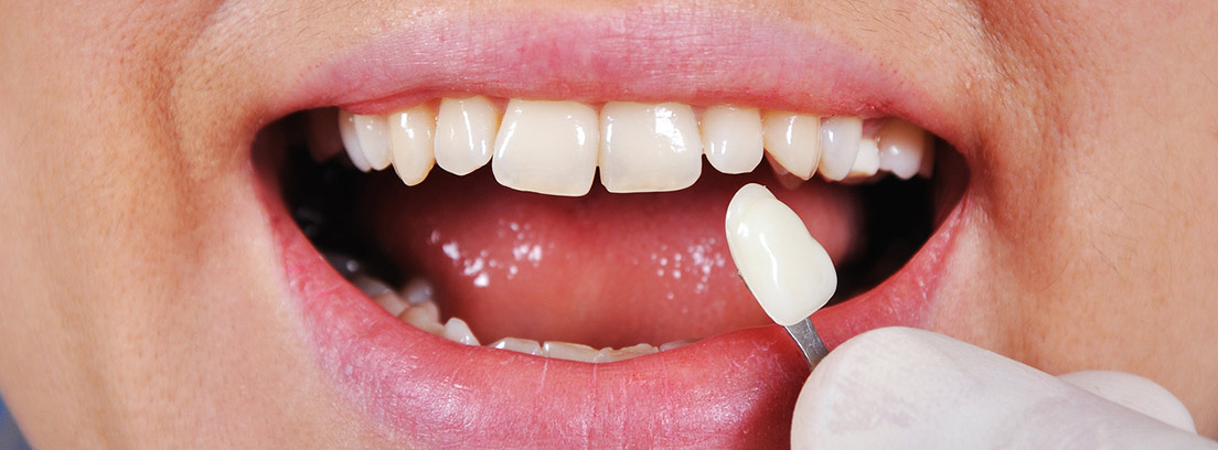 Qué son carillas dentales? precio tratamiento -canalSALUD