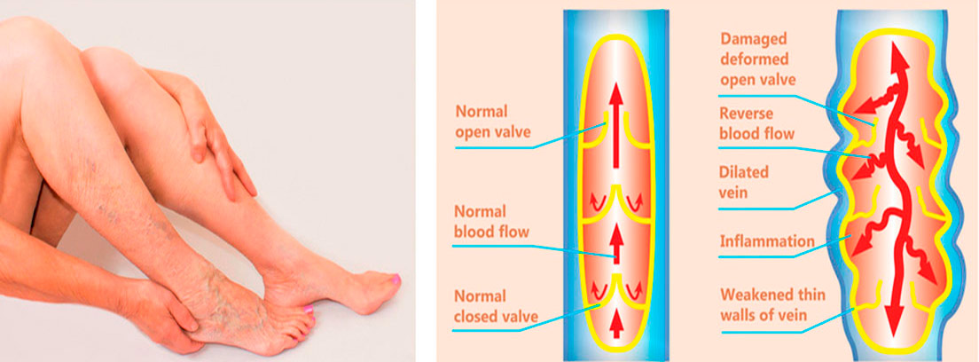 piernas de mujer y cuadro conb explicación de la insuficiencia venosa