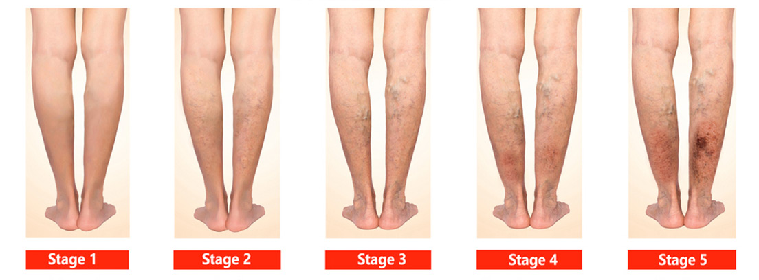 piernas en diferentes estadios de insuficiencia venosa