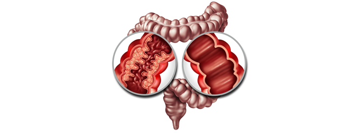 Intestino con la enfermedad de crohn