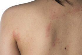 Dermatitis atopica en la espalda