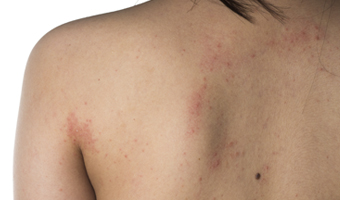 Dermatitis atopica en la espalda