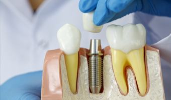 Implantes dentales