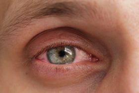 ojo irritado por conjuntivitis