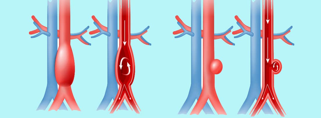 Aneurisma de aorta: dibujo de aneurisma de aorta