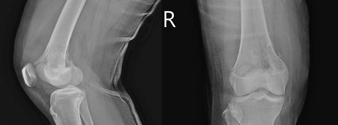 Sarcoma de Ewing: radiografía