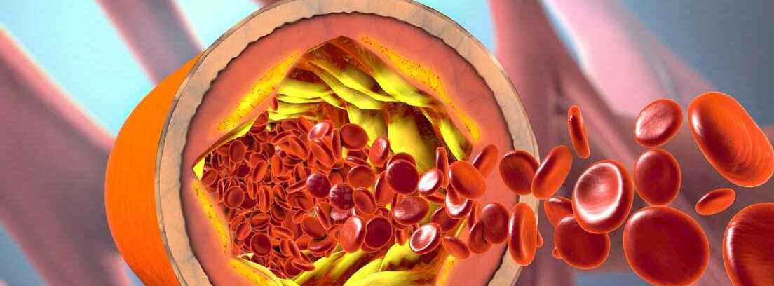 Policitemia vera: aumento de los glóbulos rojos en venas y arterias