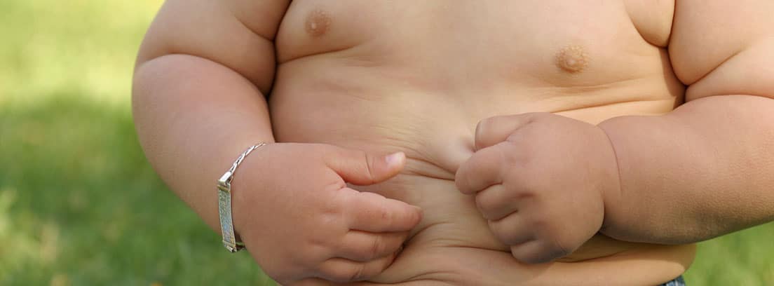 ¿Qué es el síndrome de Prader-Willi: niño con obesidad