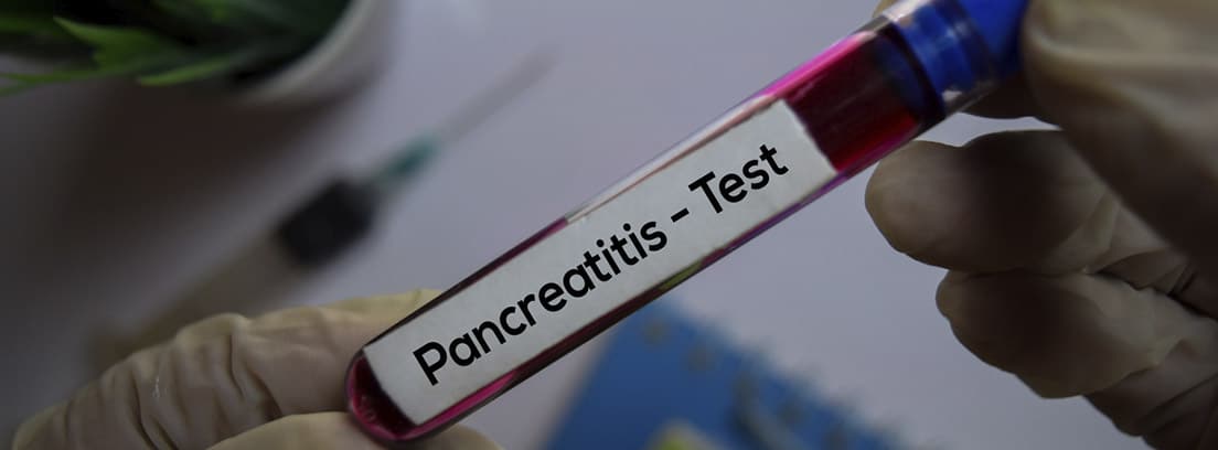 Test de la amilasa: prueba de detección de la pancreatitis. muestra en tubo de ensayo