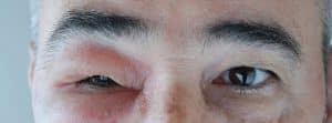 ¿Qué son los angioedemas?hombre con una inflamación en un ojo