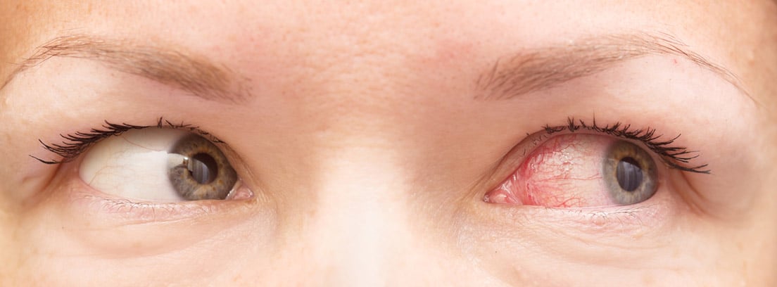 ¿Qué hacer si tenemos un derrame ocular?: ojos de mujer con un derrame en uno de ellos
